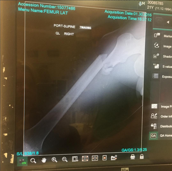 Clout Breaks Femur in Oakland